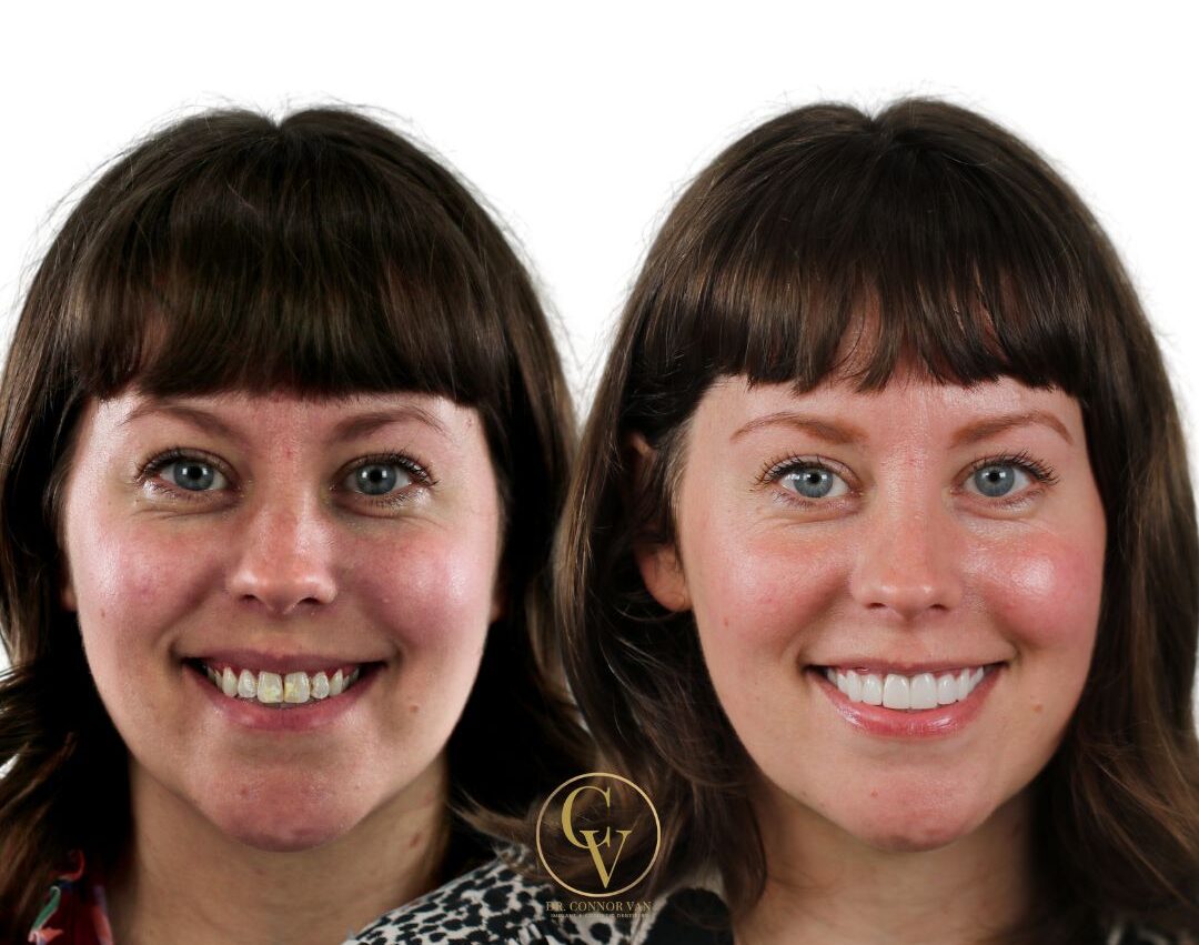 Central Florida Dental Implant before and after 10