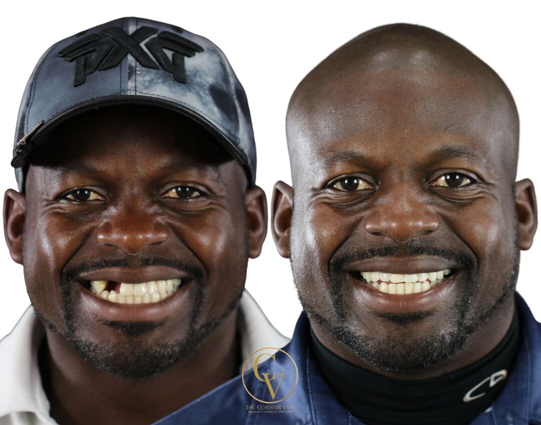 Central Florida Dental Implant before and after 11