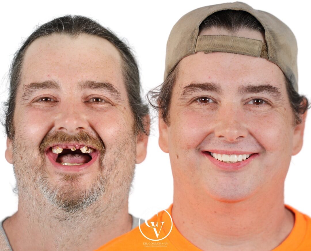 Central Florida Dental Implant before and after 12