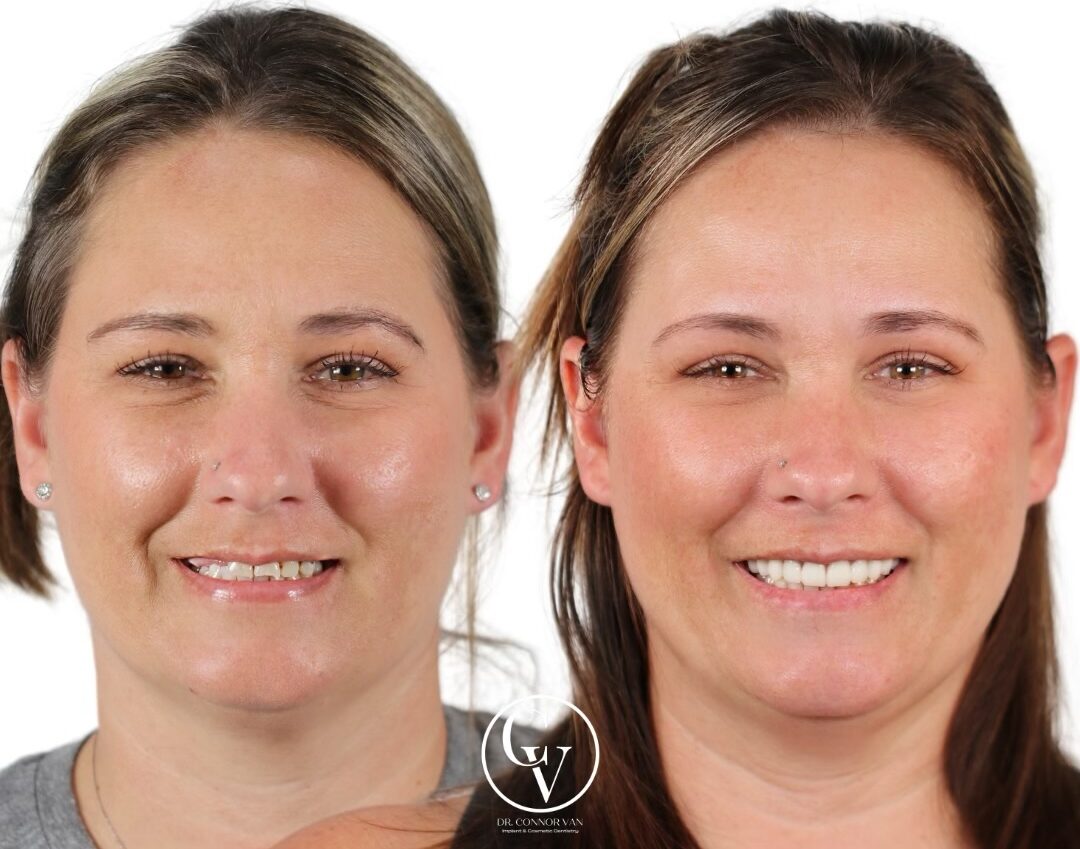 Central Florida Dental Implant before and after 13