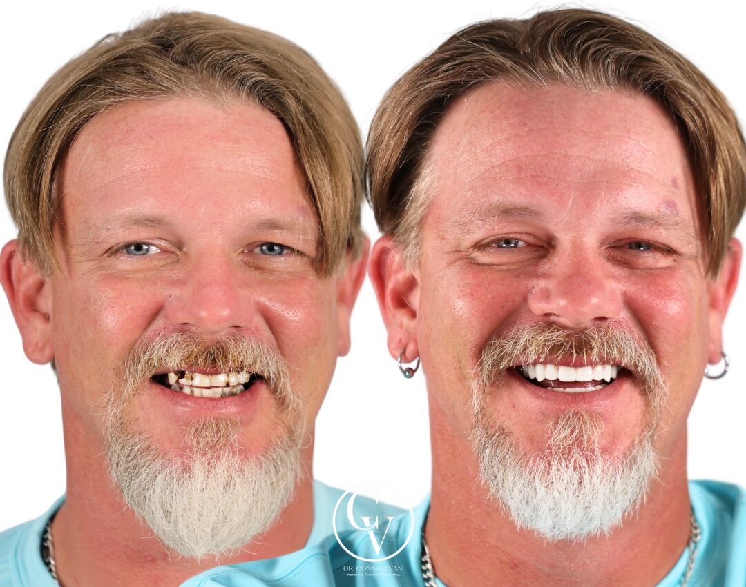 Central Florida Dental Implant before and after 14