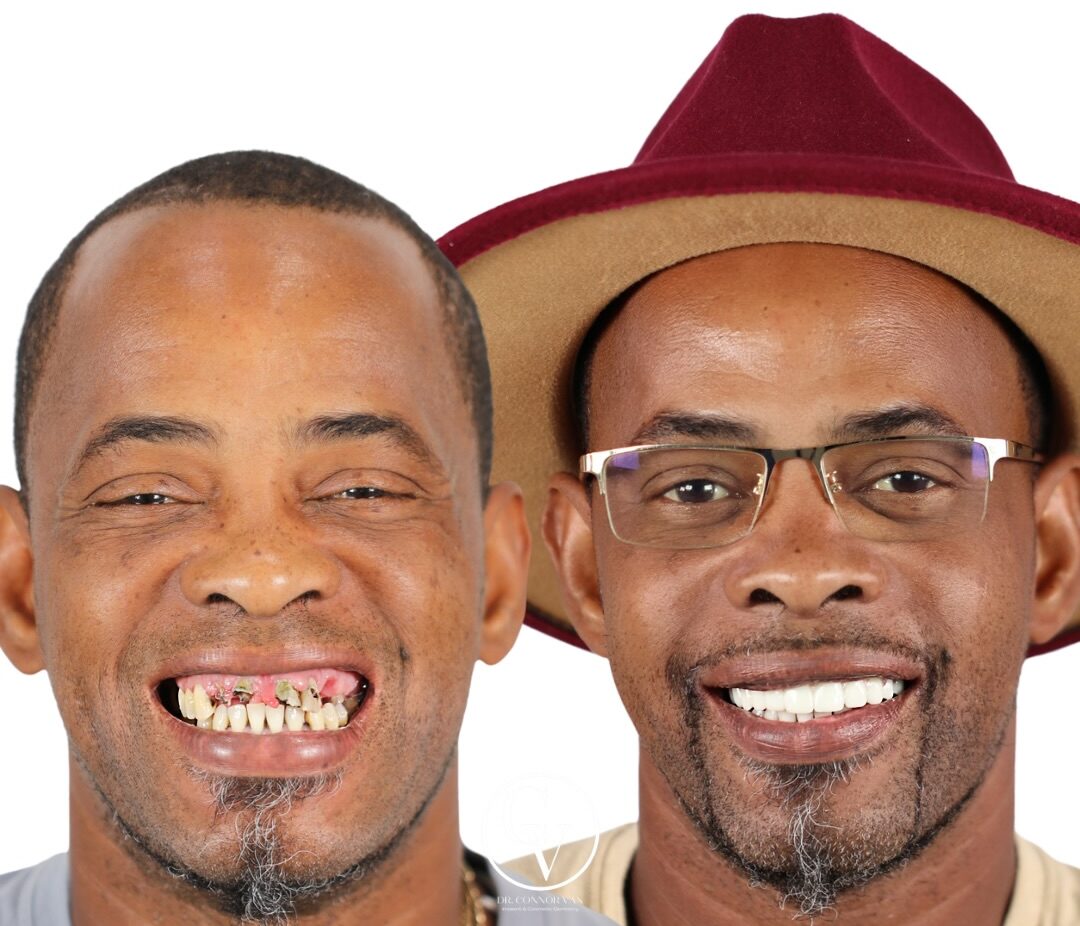 Central Florida Dental Implant before and after 15