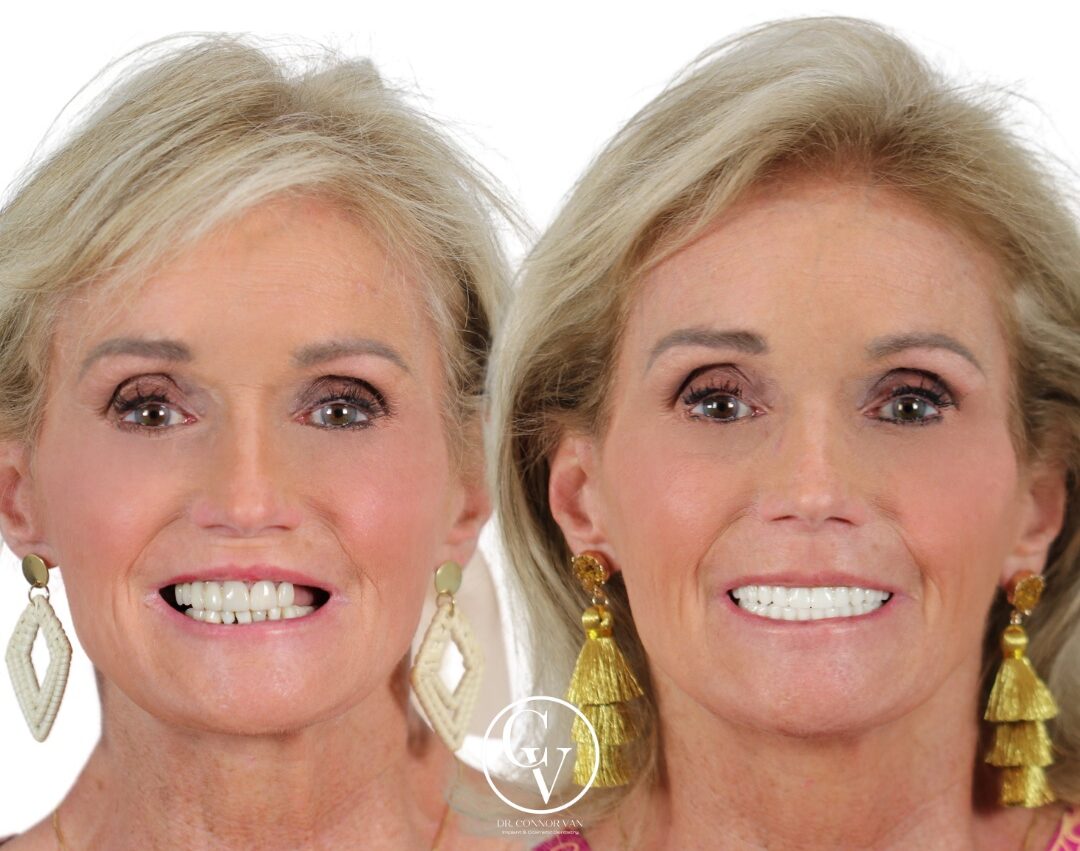 Central Florida Dental Implant before and after 16