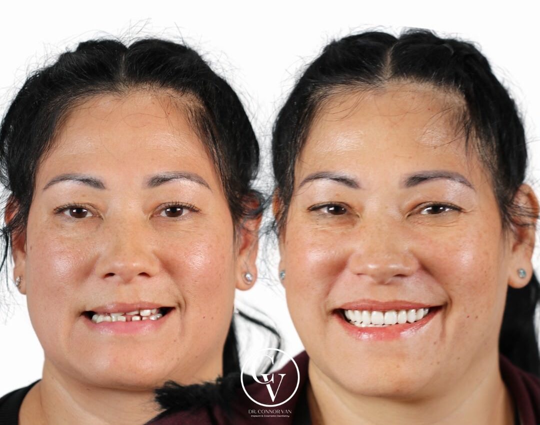Central Florida Dental Implant before and after 17