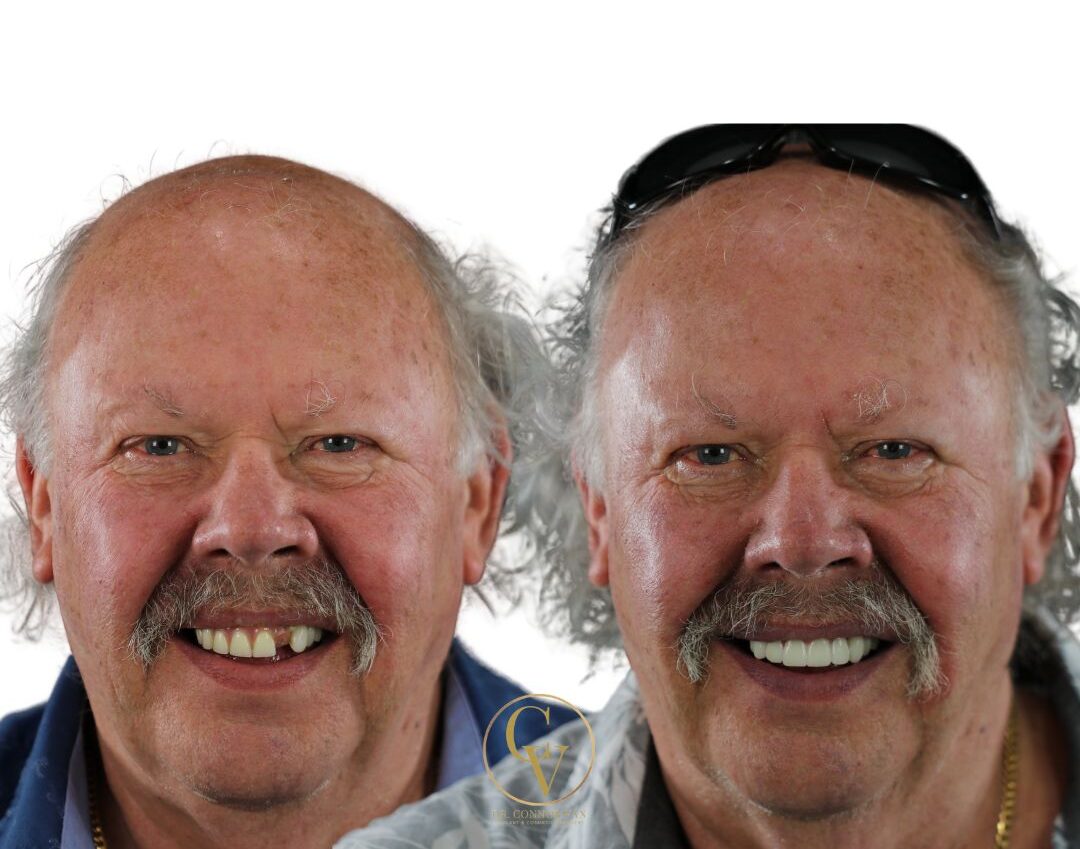 Central Florida Dental Implant before and after 7